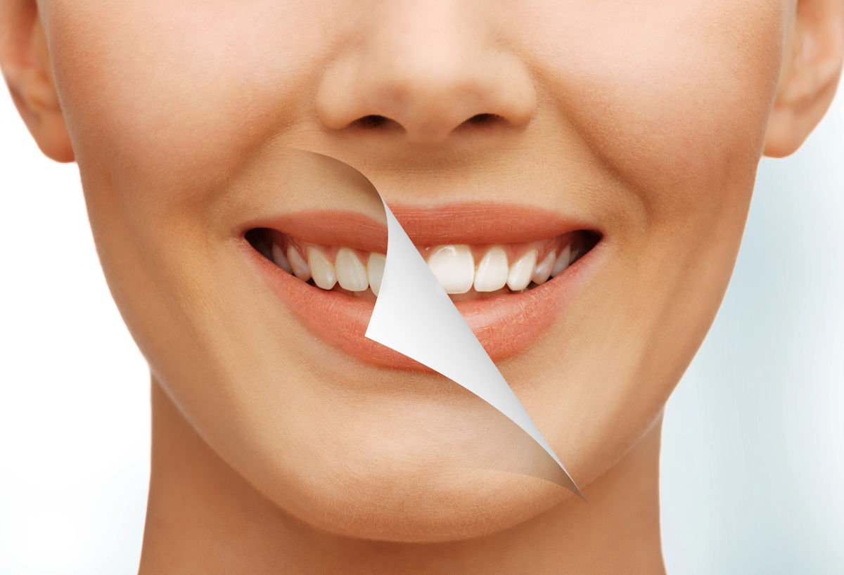 Teeth Whitening in Thailand: Cost & Methods